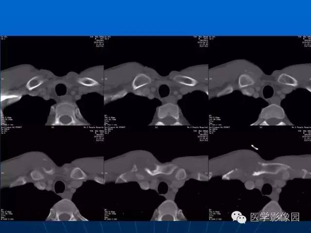 【病例】胸骨软骨肉瘤1例CT影像表现 【病例】胸骨软骨肉瘤1例CT影像表现