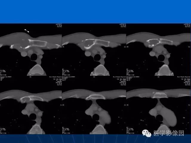 【病例】胸骨软骨肉瘤1例CT影像表现 【病例】胸骨软骨肉瘤1例CT影像表现
