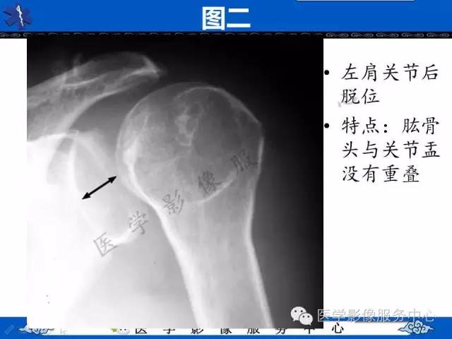 【影像征象】半月征