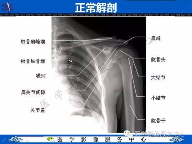 【影像征象】半月征