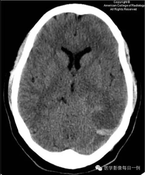 【病例】横窦静脉窦血栓1例CT及MR影像表现 【病例】横窦静脉窦血栓1例CT及MR影像表现