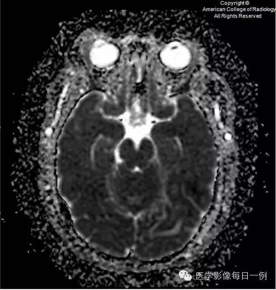 【病例】横窦静脉窦血栓1例CT及MR影像表现 【病例】横窦静脉窦血栓1例CT及MR影像表现