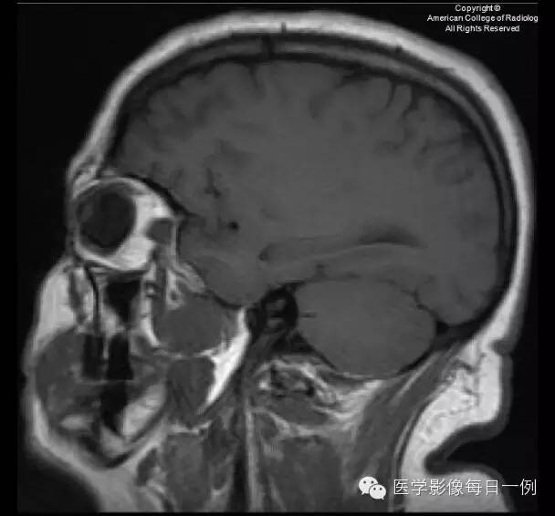 【病例】横窦静脉窦血栓1例CT及MR影像表现 【病例】横窦静脉窦血栓1例CT及MR影像表现