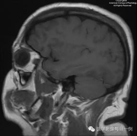 【病例】横窦静脉窦血栓1例CT及MR影像表现 【病例】横窦静脉窦血栓1例CT及MR影像表现