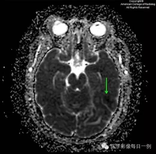 【病例】横窦静脉窦血栓1例CT及MR影像表现 【病例】横窦静脉窦血栓1例CT及MR影像表现