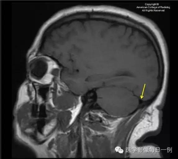 【病例】横窦静脉窦血栓1例CT及MR影像表现 【病例】横窦静脉窦血栓1例CT及MR影像表现