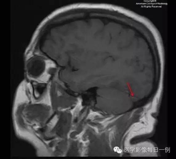 【病例】横窦静脉窦血栓1例CT及MR影像表现 【病例】横窦静脉窦血栓1例CT及MR影像表现