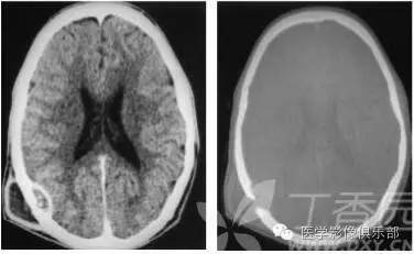 颅骨骨结核 颅骨骨结核