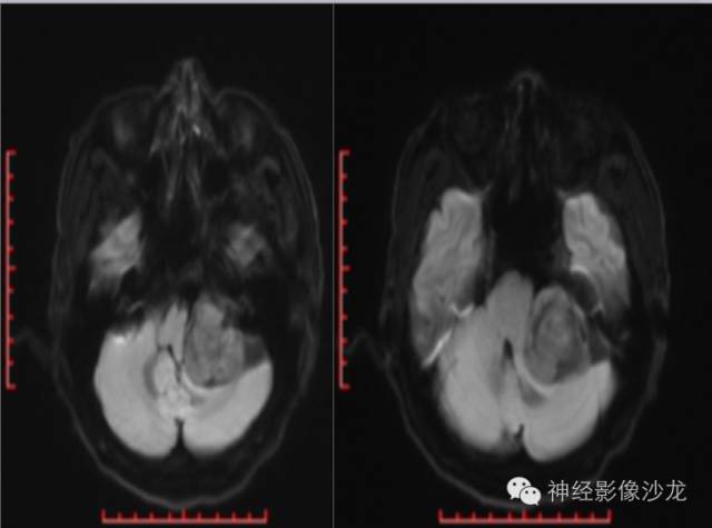 【病例】左侧CPA孤立性纤维瘤1例