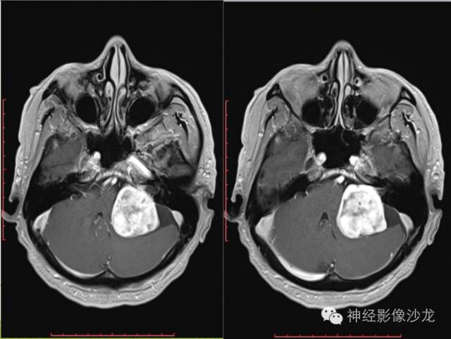 【病例】左侧CPA孤立性纤维瘤1例