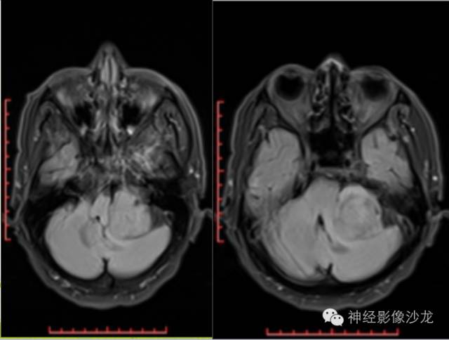 【病例】左侧CPA孤立性纤维瘤1例