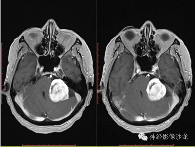 【病例】左侧CPA孤立性纤维瘤1例