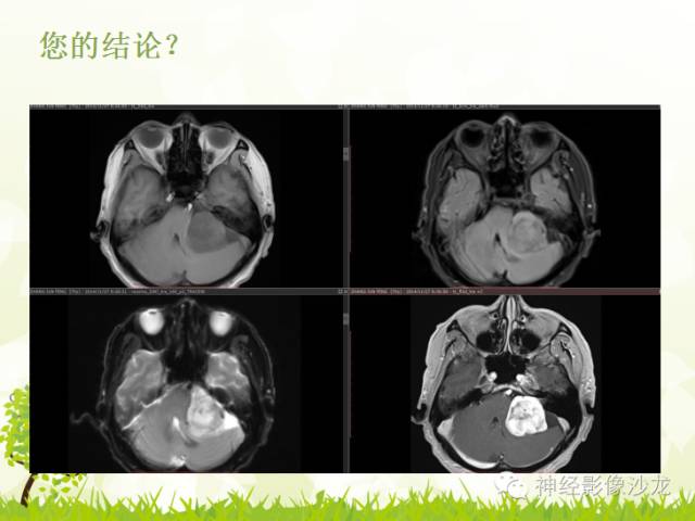 【病例】左侧CPA孤立性纤维瘤1例