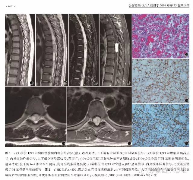 【病例】脊髓内血管母细胞瘤1例MR影像诊断分析