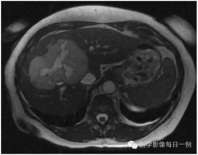 【病例】肝脏巨大海绵状血管瘤1例