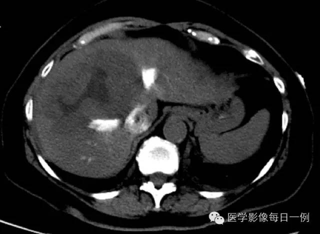 【病例】肝脏巨大海绵状血管瘤1例