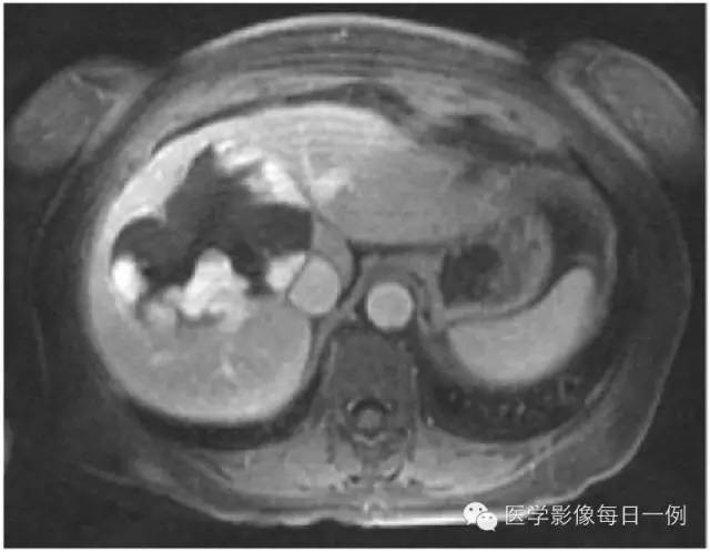 【病例】肝脏巨大海绵状血管瘤1例