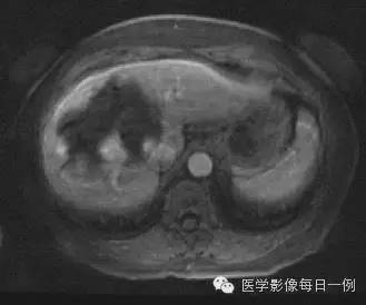 【病例】肝脏巨大海绵状血管瘤1例