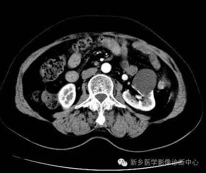肾脏囊性病变的Bosniak分型 肾脏囊性病变的Bosniak分型