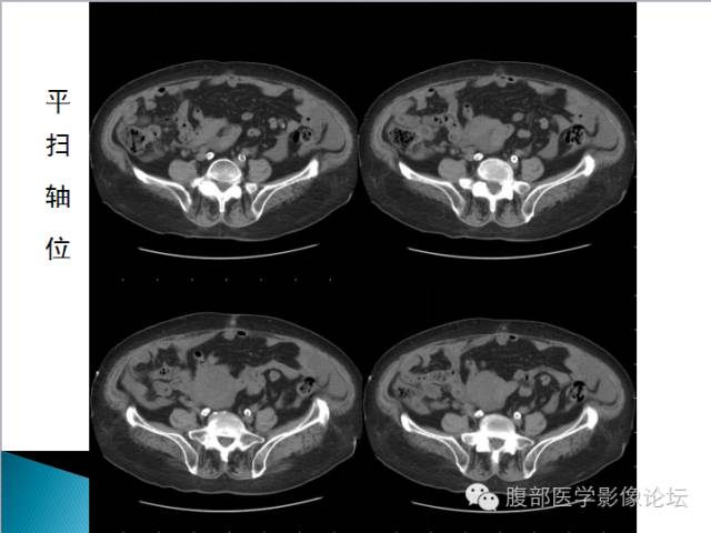 【病例】卵巢性索间质肿瘤1例CT影像表现 【病例】卵巢性索间质肿瘤1例CT影像表现