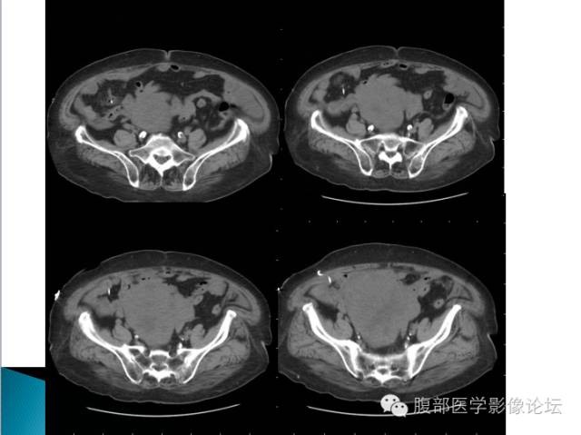 【病例】卵巢性索间质肿瘤1例CT影像表现 【病例】卵巢性索间质肿瘤1例CT影像表现