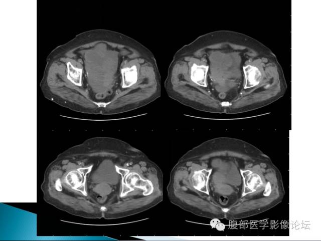 【病例】卵巢性索间质肿瘤1例CT影像表现 【病例】卵巢性索间质肿瘤1例CT影像表现