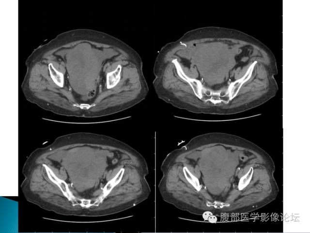 【病例】卵巢性索间质肿瘤1例CT影像表现 【病例】卵巢性索间质肿瘤1例CT影像表现