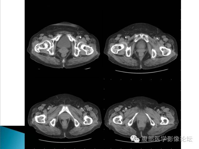 【病例】卵巢性索间质肿瘤1例CT影像表现 【病例】卵巢性索间质肿瘤1例CT影像表现