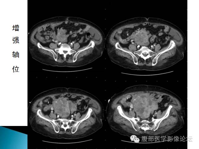 【病例】卵巢性索间质肿瘤1例CT影像表现 【病例】卵巢性索间质肿瘤1例CT影像表现