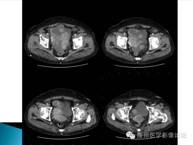 【病例】卵巢性索间质肿瘤1例CT影像表现 【病例】卵巢性索间质肿瘤1例CT影像表现