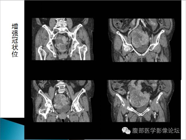 【病例】卵巢性索间质肿瘤1例CT影像表现 【病例】卵巢性索间质肿瘤1例CT影像表现