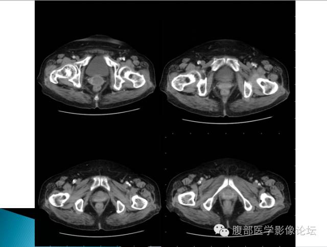 【病例】卵巢性索间质肿瘤1例CT影像表现 【病例】卵巢性索间质肿瘤1例CT影像表现