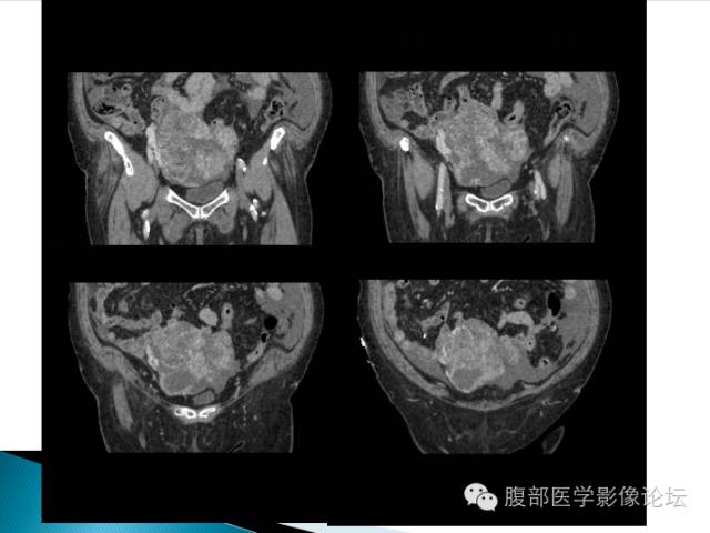 【病例】卵巢性索间质肿瘤1例CT影像表现 【病例】卵巢性索间质肿瘤1例CT影像表现