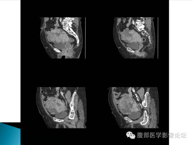 【病例】卵巢性索间质肿瘤1例CT影像表现 【病例】卵巢性索间质肿瘤1例CT影像表现