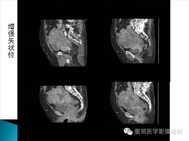 【病例】卵巢性索间质肿瘤1例CT影像表现 【病例】卵巢性索间质肿瘤1例CT影像表现