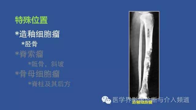 【PPT】识骨寻踪系列二——从病变的位置找到诊断线索