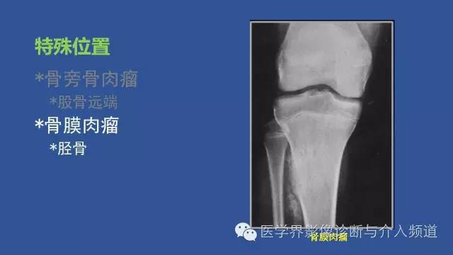 【PPT】识骨寻踪系列二——从病变的位置找到诊断线索