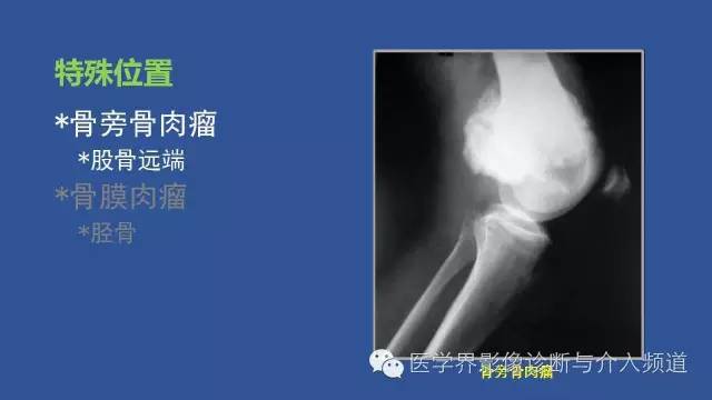 【PPT】识骨寻踪系列二——从病变的位置找到诊断线索