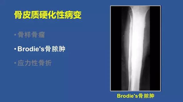【PPT】识骨寻踪系列三——病变密度提示那些诊断线索