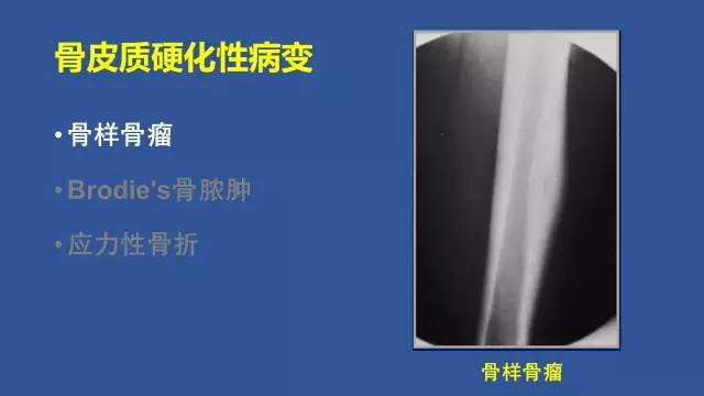 【PPT】识骨寻踪系列三——病变密度提示那些诊断线索