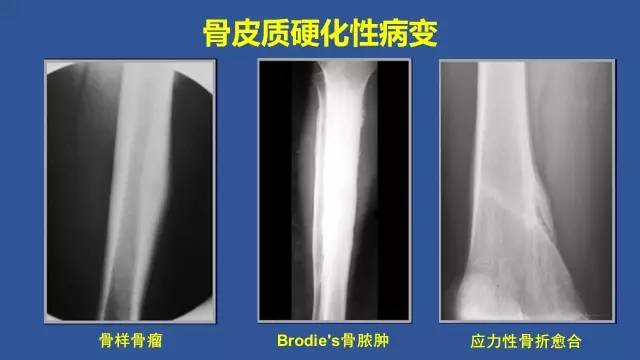 【PPT】识骨寻踪系列三——病变密度提示那些诊断线索