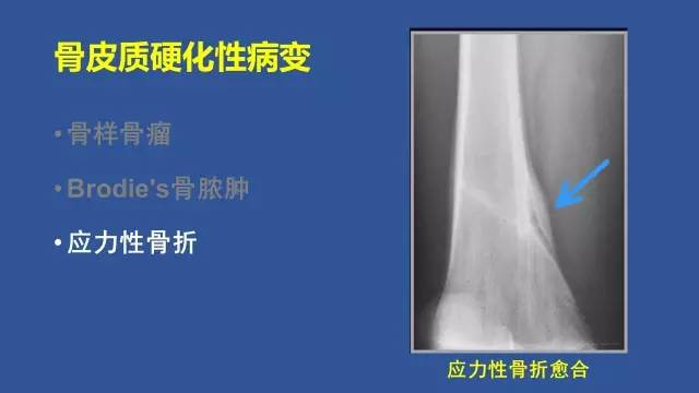 【PPT】识骨寻踪系列三——病变密度提示那些诊断线索