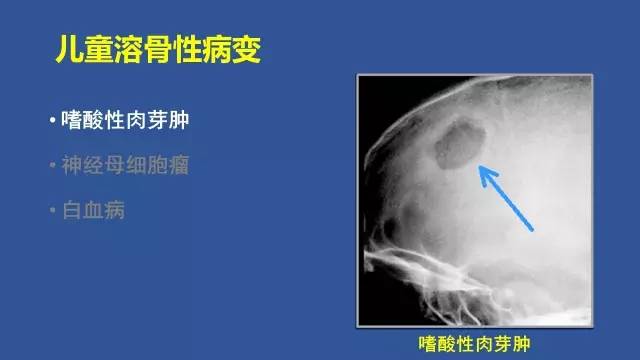 【PPT】识骨寻踪系列三——病变密度提示那些诊断线索
