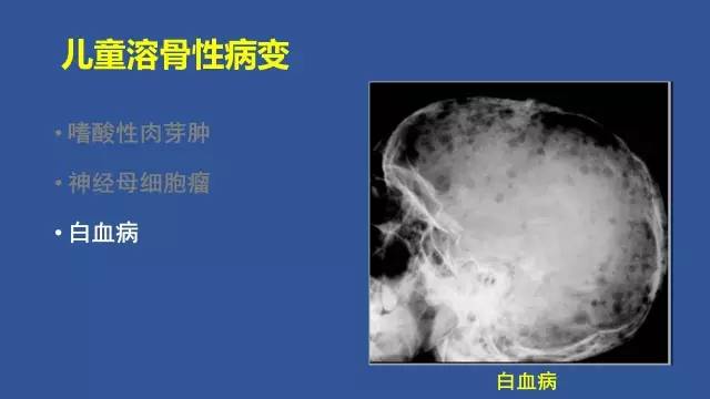 【PPT】识骨寻踪系列三——病变密度提示那些诊断线索