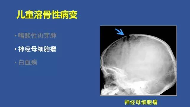 【PPT】识骨寻踪系列三——病变密度提示那些诊断线索