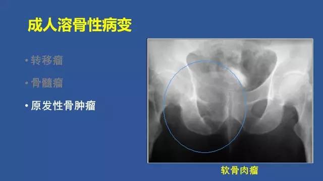 【PPT】识骨寻踪系列三——病变密度提示那些诊断线索