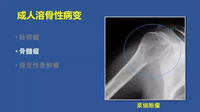 【PPT】识骨寻踪系列三——病变密度提示那些诊断线索