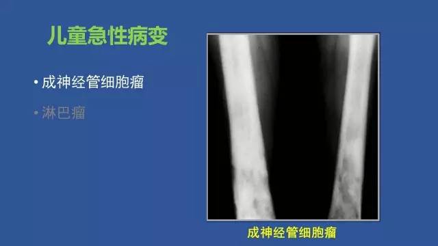 【PPT】识骨寻踪系列三——病变密度提示那些诊断线索