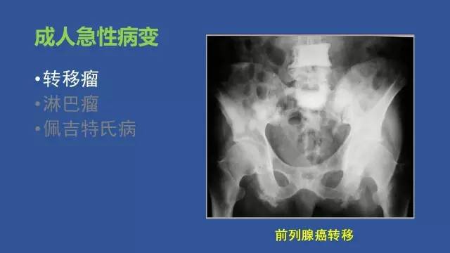 【PPT】识骨寻踪系列三——病变密度提示那些诊断线索