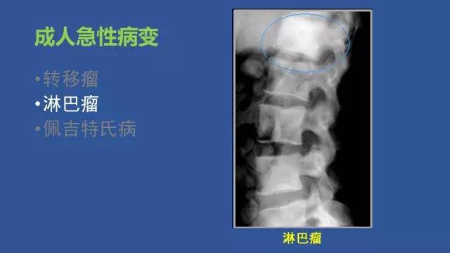 【PPT】识骨寻踪系列三——病变密度提示那些诊断线索